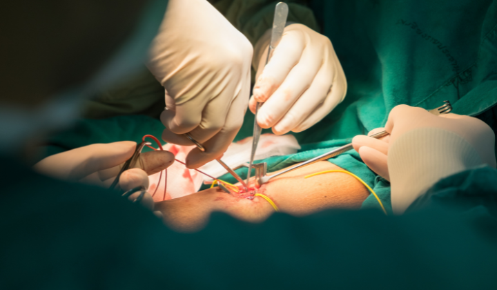 Opération des veines