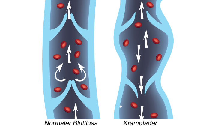 Blutfluss bei Krampfadern